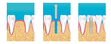 Implant dentaire Paris 9 Schéma représentatif du protocole implantaire